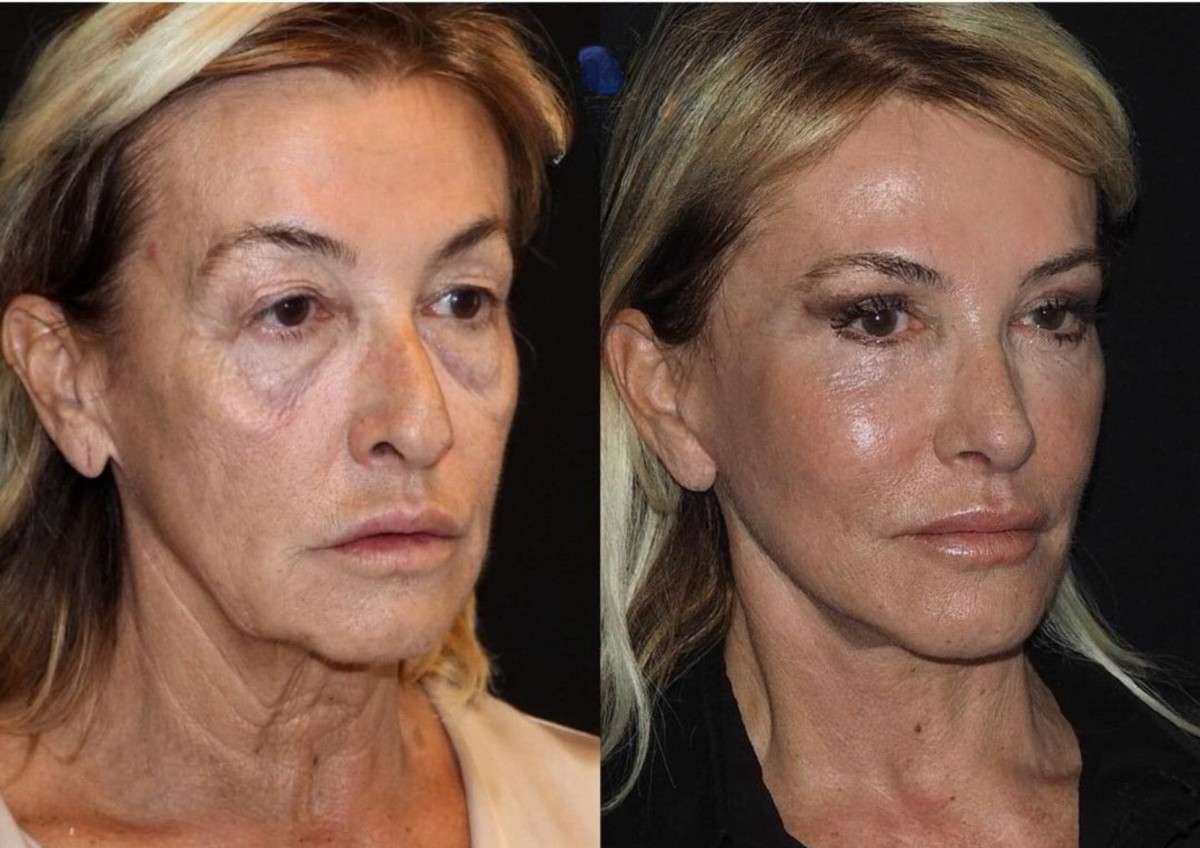 Prima e dopo XFILLER
