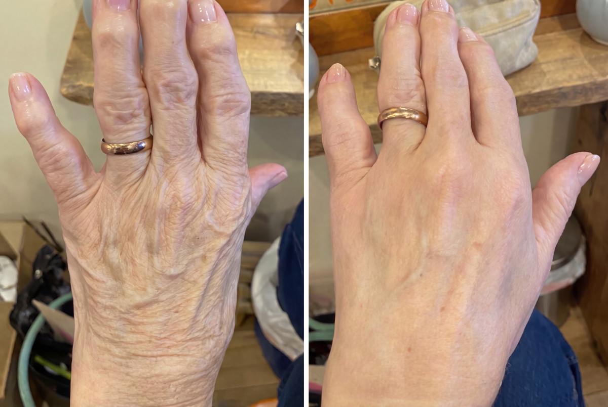 Prima e dopo XFILLER